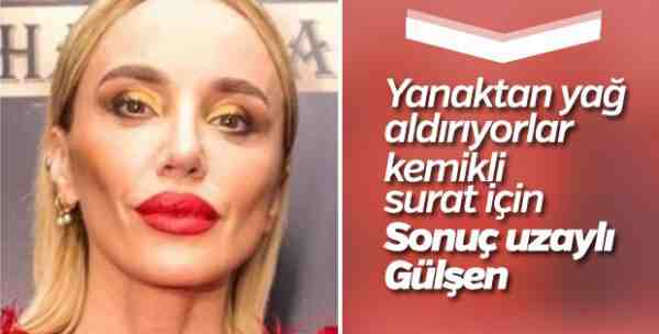 Hollywood yanağı nedir